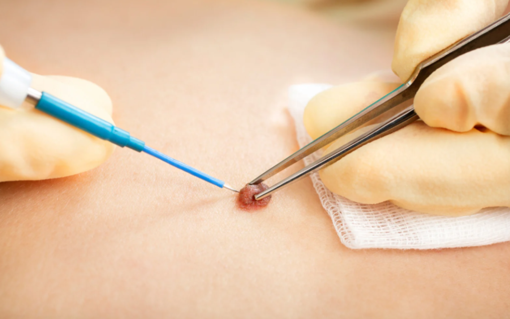 הסרת נקודות חן בפלזמה